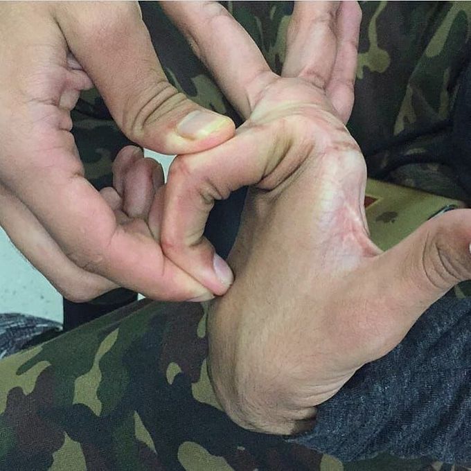Extreme hypermobility of the finger! Do you know which genetic disorder is this typical for? 