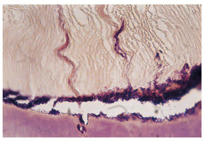 Progression of dental caries