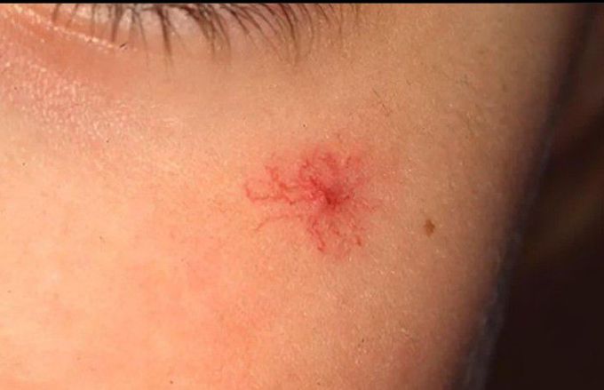 Spider angioma