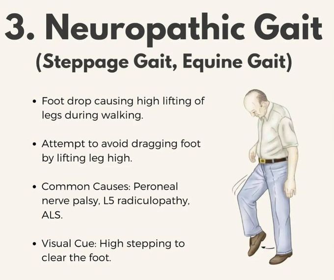 Neuropathic Gait