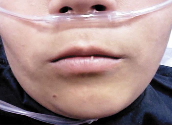Perioral Myokymia