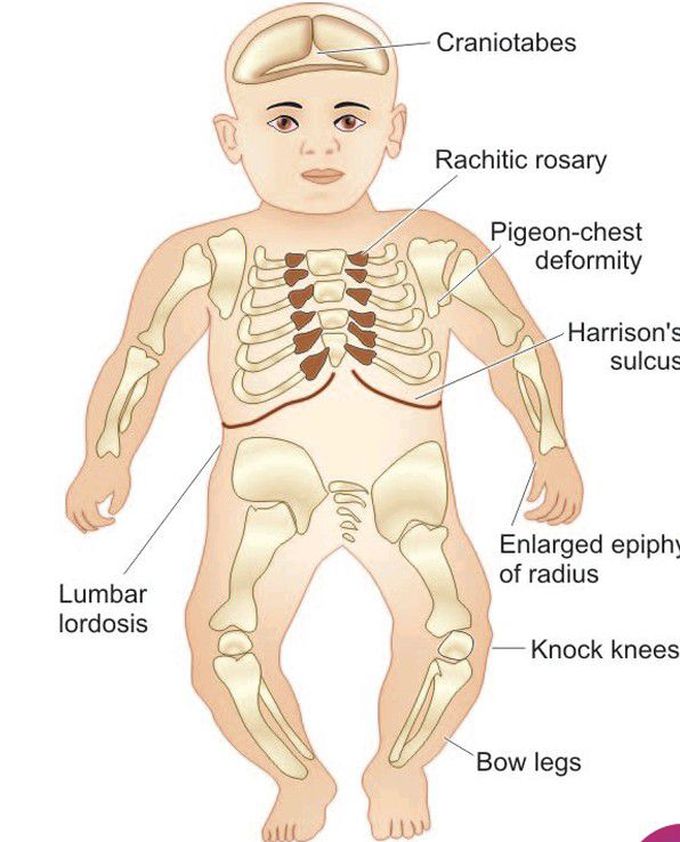 Lesions in rickets