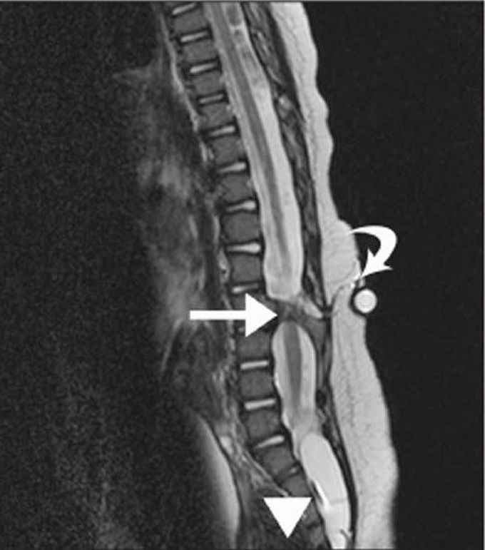 Diastematomyelia