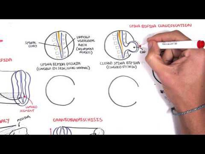 Introduction to Neural Tube Defects