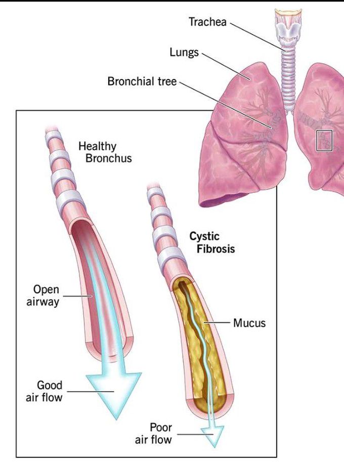 Cystic fibrosis