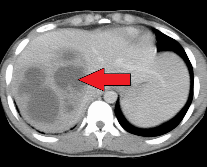 Symptoms of liver abscess