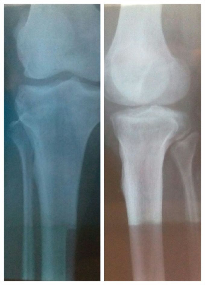 Xray right knee