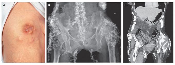 Dystrophic Calcinosis Cutis