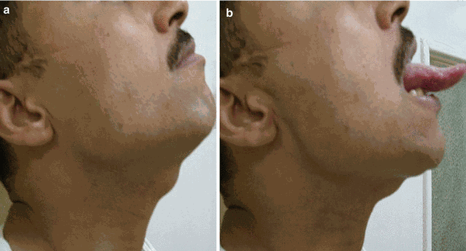 Thyroglossal Duct Cyst - Before and After Tongue Protrusion