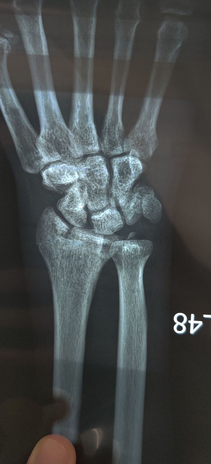 Radius Fracture