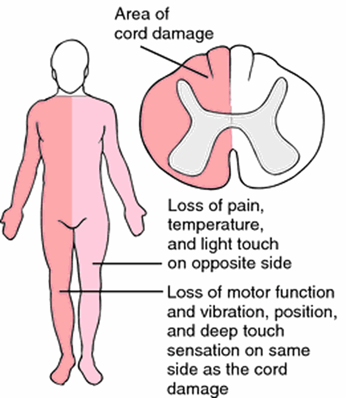 Treatment of brown sequard syndrome