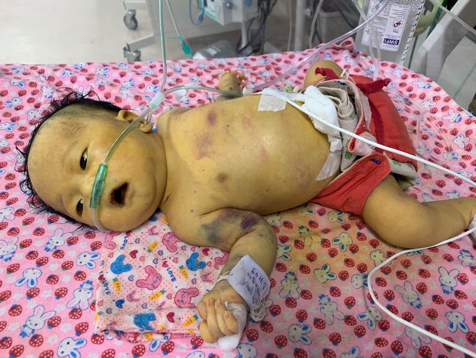 Severe sepsis