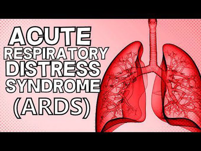Introduction to ARDS (Acute Respiratory Distress Syndrome)
