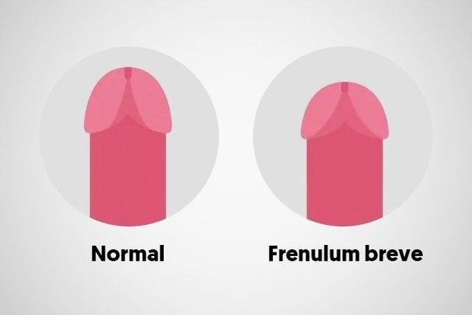 Causes of frenulum breve