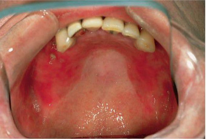 Erythmatous candidiasis