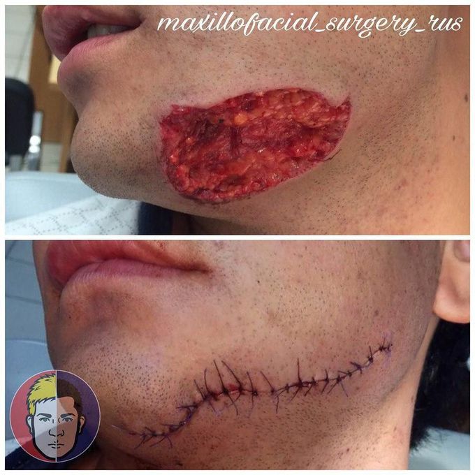 Butten wound
