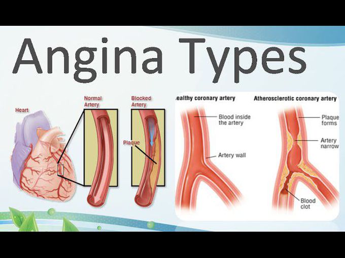 Types of Angina Pectoris