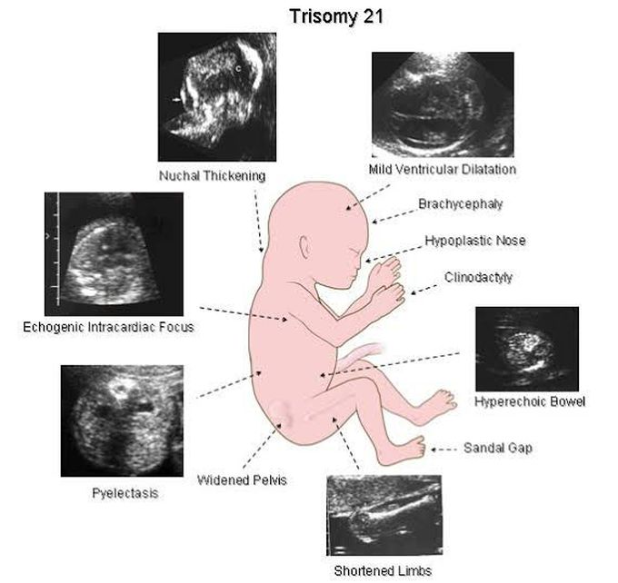 Ultrasound Finding For Down Syndrome