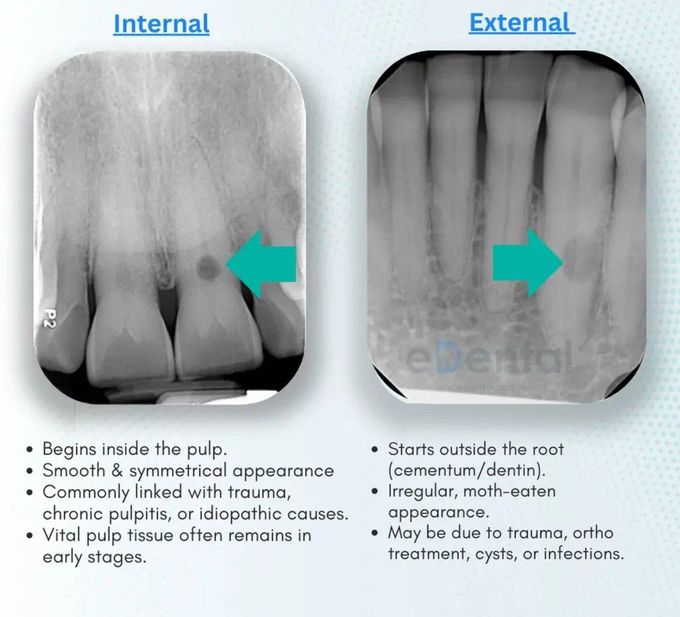 Tooth Resorption