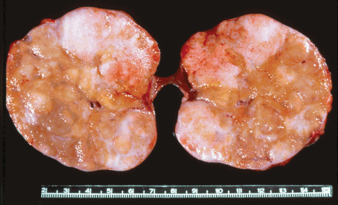 Symptoms of Brenner tumor
