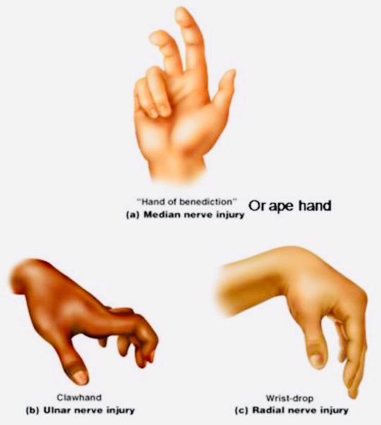 Injuries of the nerves in the hands