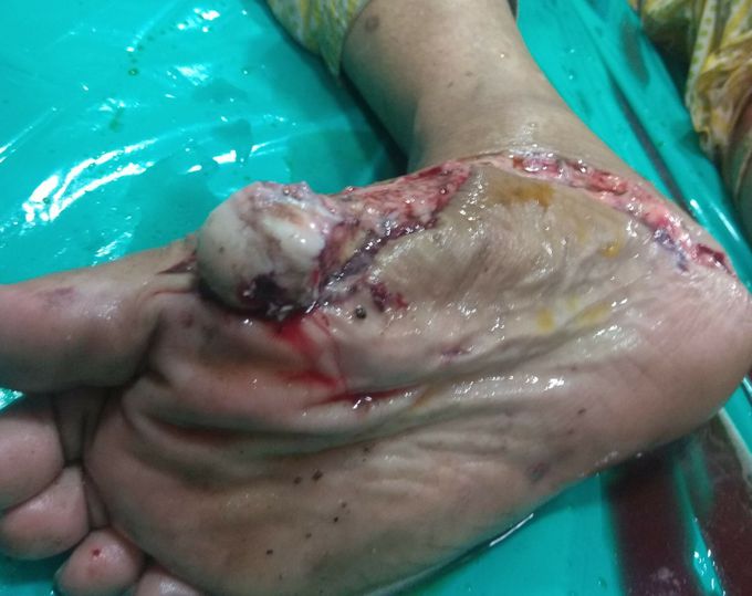 Traumatic foot injury.