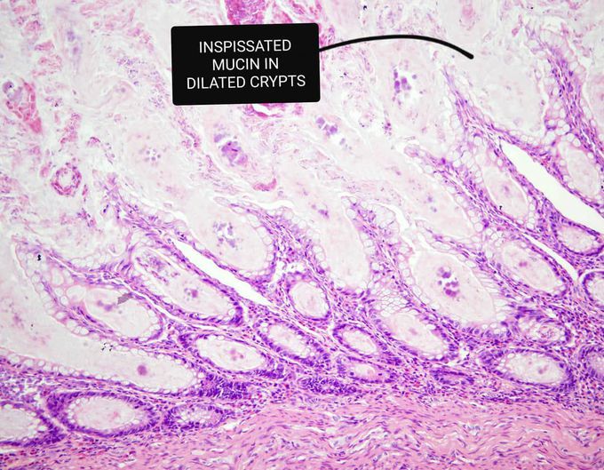 Cystic fibrosis of intestine