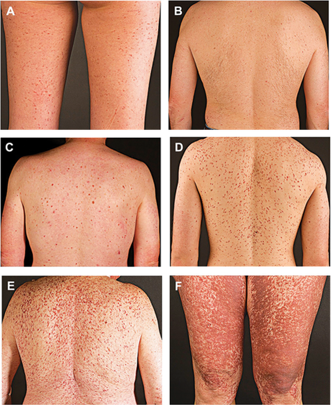 Maculopapular cutaneous mastocytosis