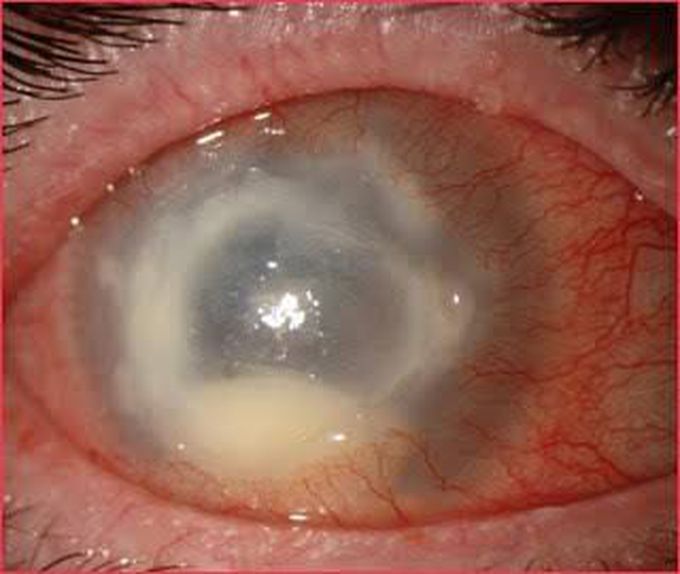 Acanthamoeba Keratitis