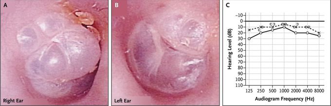 Hyperectasis of the Tympanic Membrane