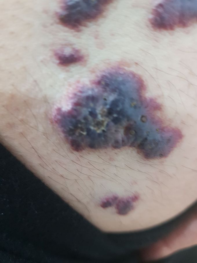 Hemangioma that has been painful and swelling since 1 year ago
