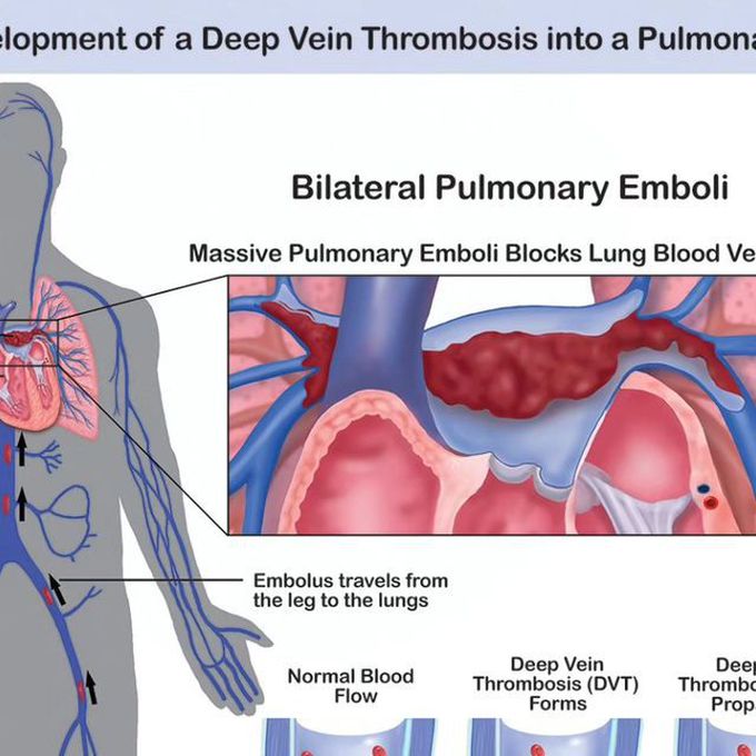 Pulmonary emboli