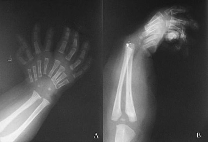 Mirror Hand Syndrome