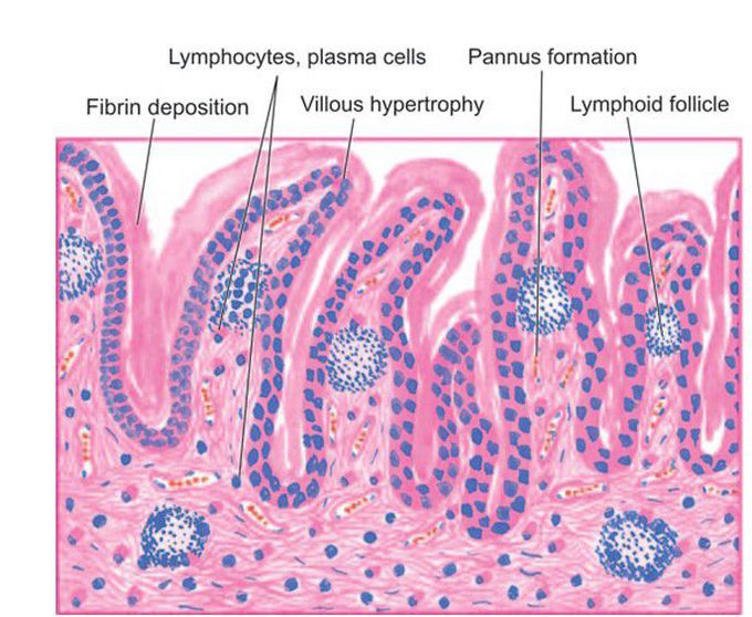 Rheumatoid arthritis.