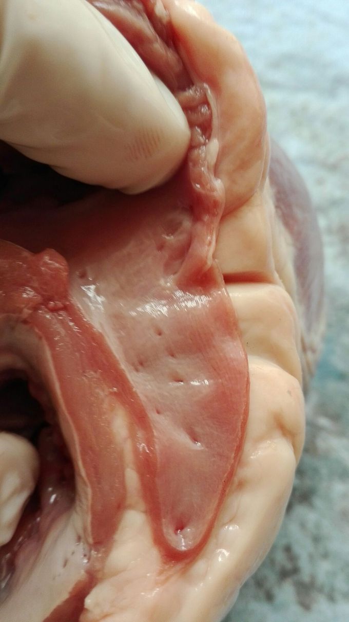 Coronary artery