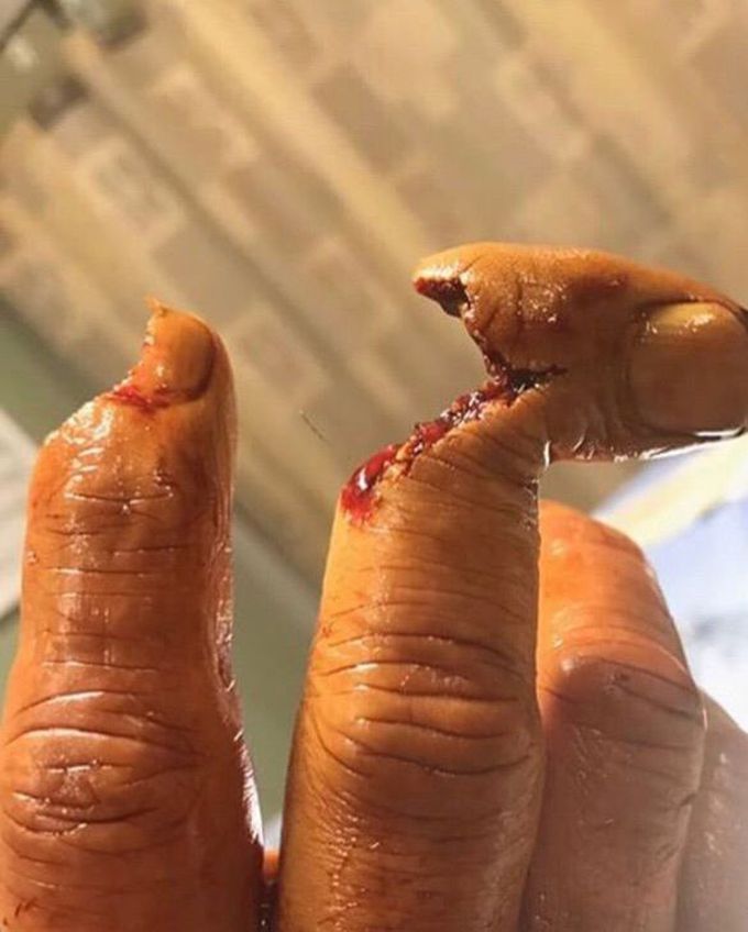 Butcher band saw accident!!!