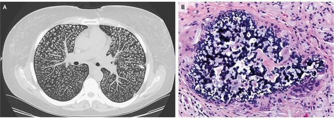 Pulmonary Foreign-Body Granulomatosis