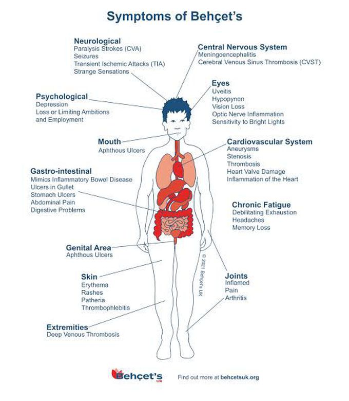 Symptoms of behcet disease