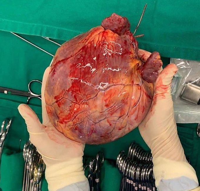 A mega-size globular heart!!
