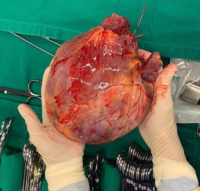 A mega-size globular heart!!