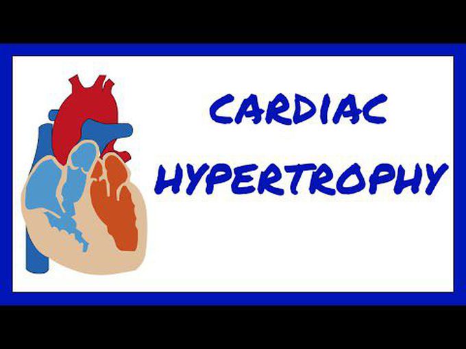 Cardiac hypertrophy precise review
