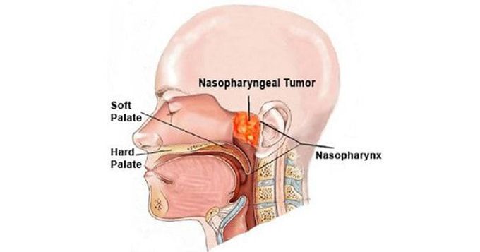 Trotter’s Triad in Nasopharyngeal Carcinoma