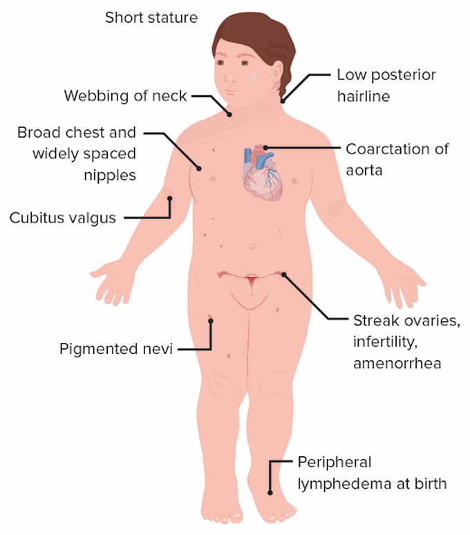 These are the symptoms of Turners syndrome