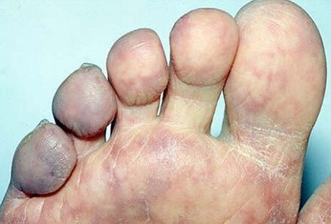 Purple toes syndrome