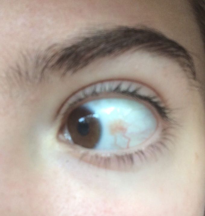 Permanent Red Eye That Worsens In Severity