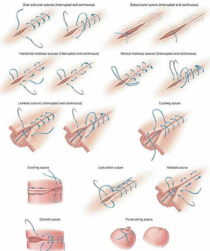 Different types of surgical suture