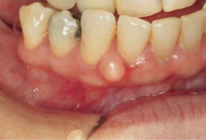 Gingival cyst