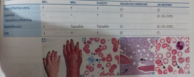 Myeloproliferative Neoplasm