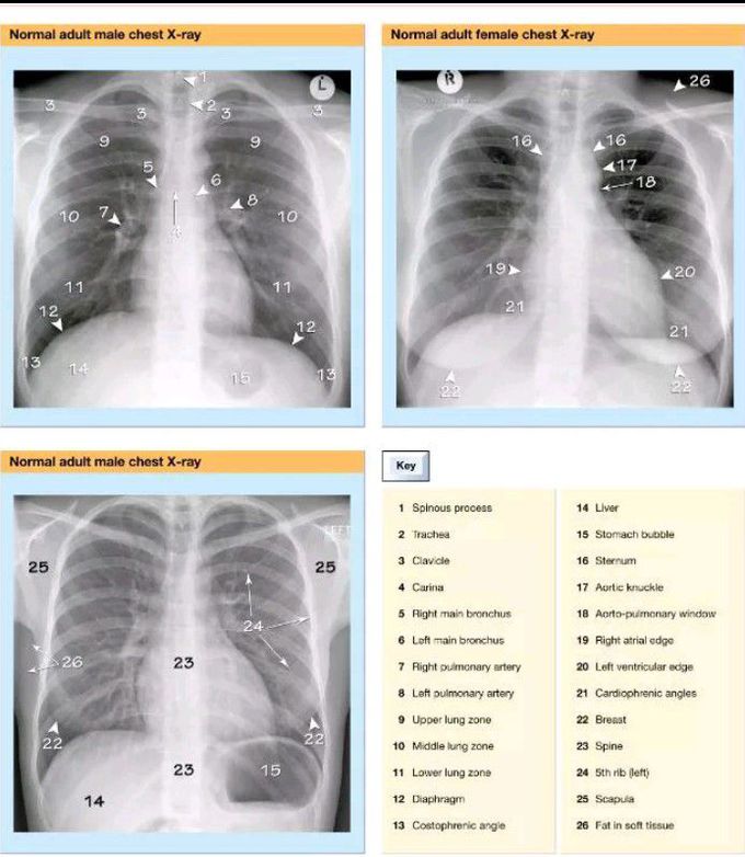 X ray