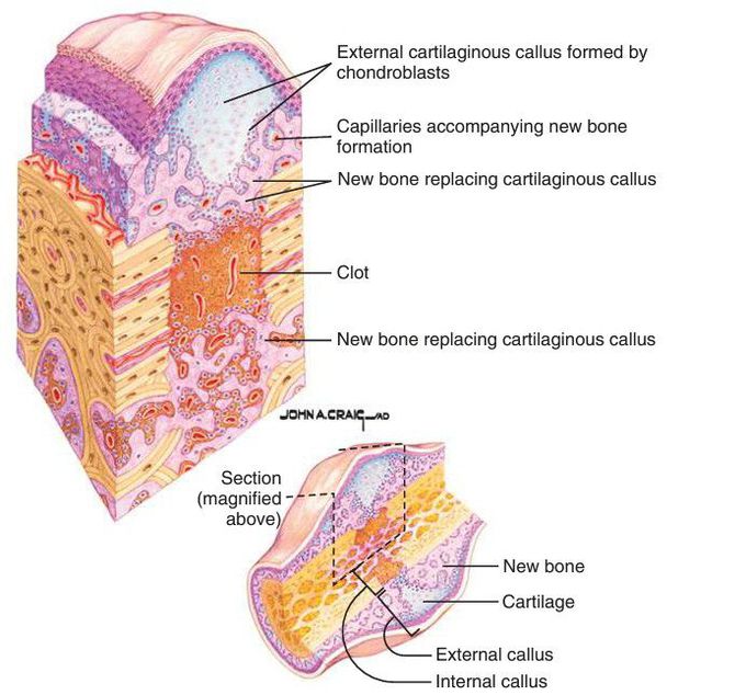 Fibroplastic stage of wound healing